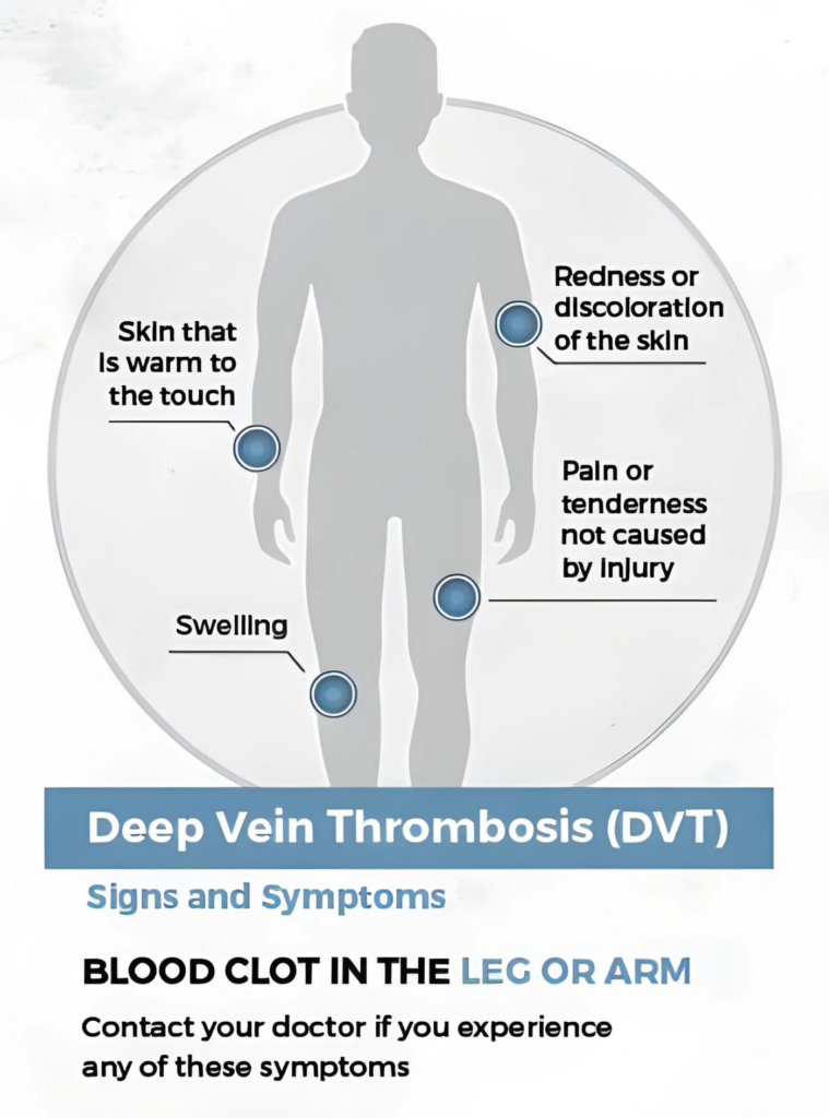 Signs and Symptoms of Blood Clots